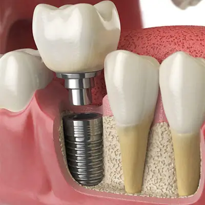 couronne unitaire sur implant 
