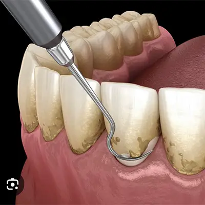détartrage suivi d’un polissage pour effacer les taches de coloration