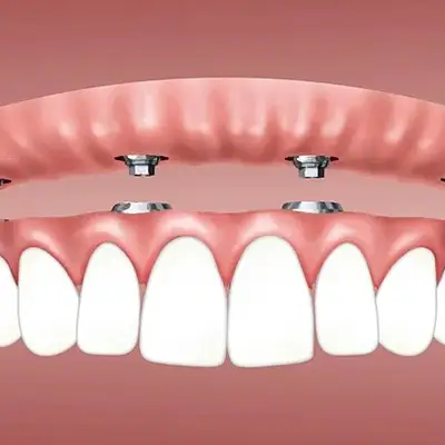 prothèse transvissée sur implant